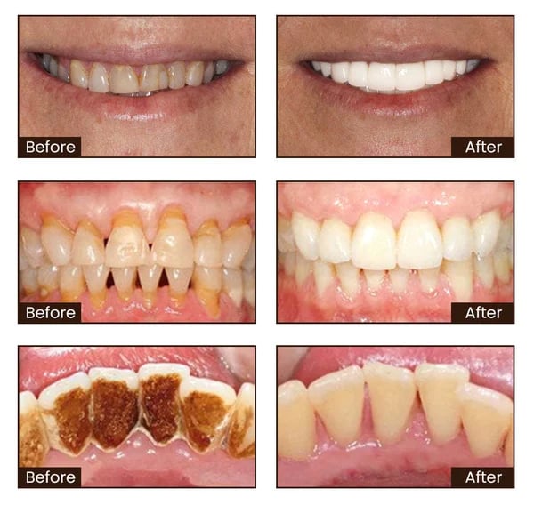 BrightSmile Whitening Toothpaste